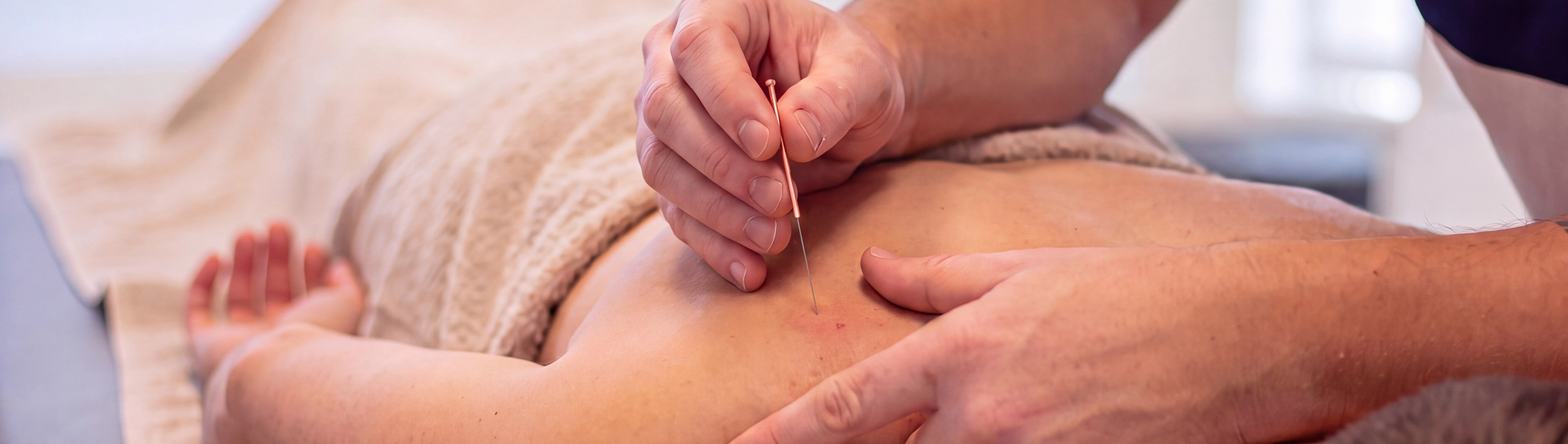 Dry needling