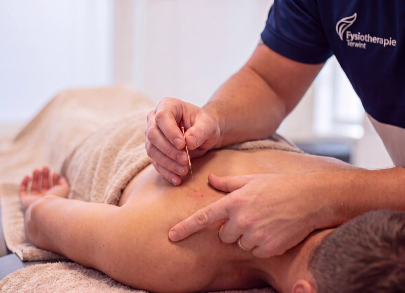 Dry needling